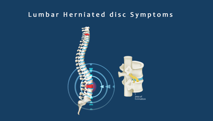 Read more about the article 什么是腰椎间盘突出症